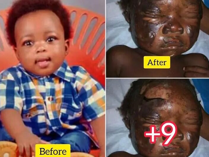 “She Deserves To Be Arrested” 2nd Wife Pours Boiling Water At 8 Months Old Baby’s Face For Crying When She Was Asleep ( Photo ) ‎